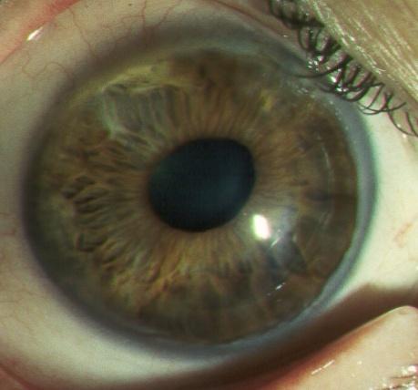 274 Diagnosis and Management of Astigmatism Fig. 1. Keratoglobus. Notice the generalized peripheral thinning.