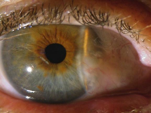 (7) (8) (9) Pterygium removal surgery improves these changes, but regular astigmatism and higher order irregularities may remain.