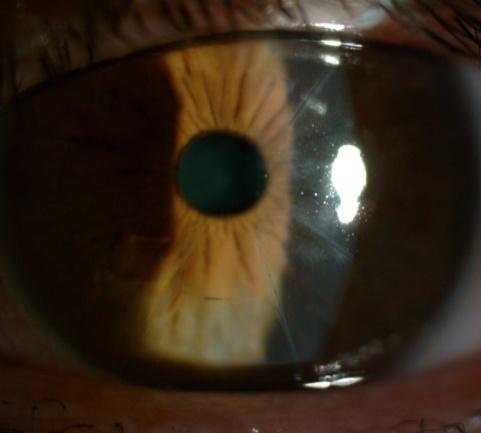 276 Diagnosis and Management of Astigmatism 4) Endothelial (Fuchs endothelial dystrophy, Posterior polymorphous dystrophy, Congenital hereditary endothelial dystrophy 1 and 2 and X-linked endothelial