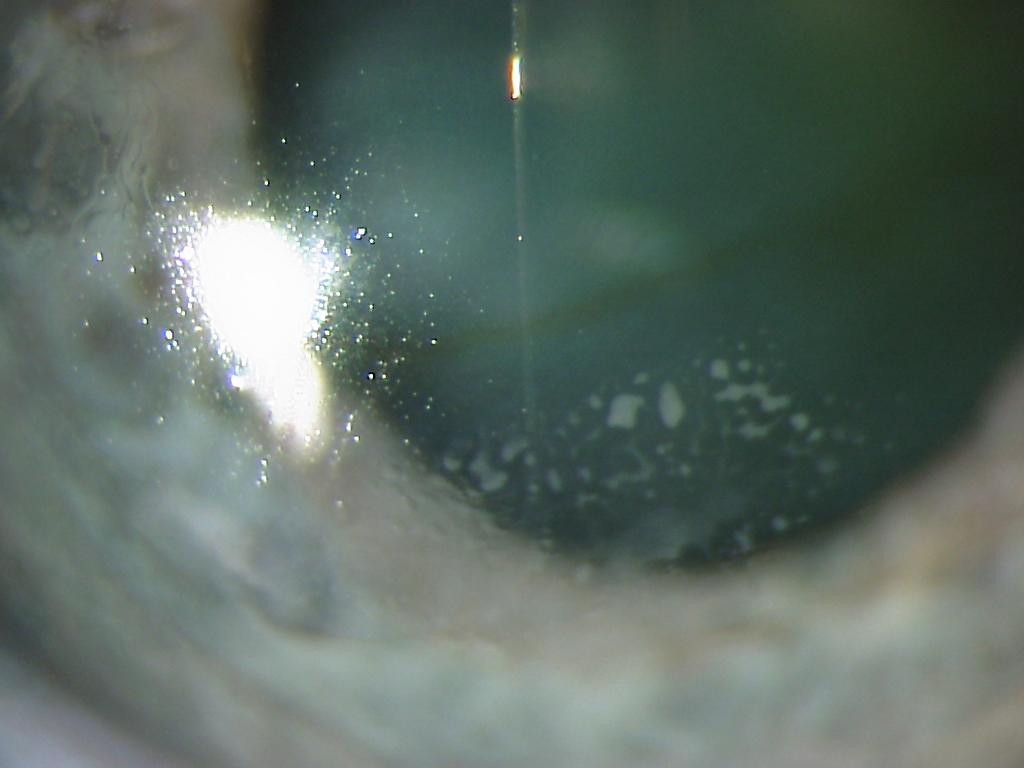 Measurement and Topography Guided Treatment of Irregular Astigmatism 277 mechanical epithelial removal, corneal haze and scarring and