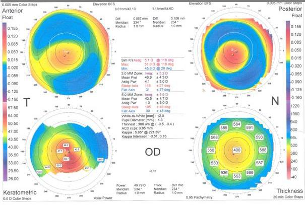 Measurement and Topography Guided Treatment of Irregular Astigmatism 279 Fig. 6. Keratoconus. The irregularity in the 3 and 5mm zone is 5.2 and 5.6 (higher than 1.5D and 2.