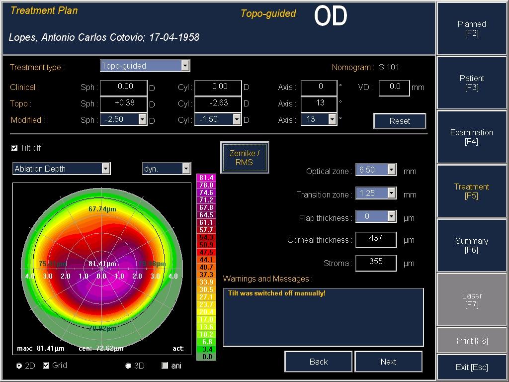 288 Diagnosis and Management of Astigmatism Fig. 13.3 Fig. 13. The first screen shows the ablation profile with no values introduced in the Clinical and Modified boxes.
