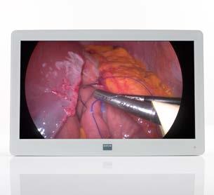 The power of High Definition High Defi nition technology is rapidly fi nding its way to the surgery suite.