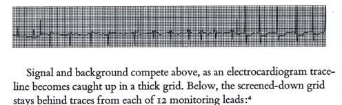 Layering: Gridlines Layering: Gridlines Electrocardiogram