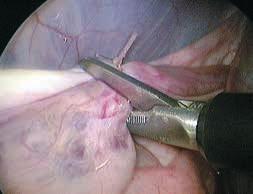 deferens 3 6 Endoscopic photograph on
