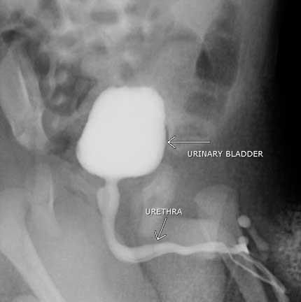 Imaginea de mai sus reprezintă cele 5 grade de reflux vezico ureteral la copil. Imagine de cistografie micţională la copil ( www.radiologyinfo.org).