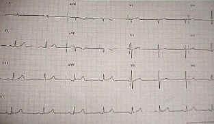 QRS, raportul R/S, unda Q, segmentul ST şi unda T. Cel mai adesea EKG-ul se poate realiza în condiţii de ambulator dar se mai poate face deasemenea în spital.