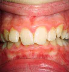 Se estimează că aproximativ 99% dintre adulţii din statele dezvoltate suferă la un moment dat de o boală sau de o malformaţie a dinţilor.