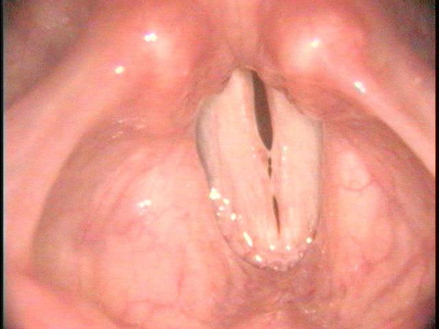 eeeee sound or /i/ opens up the pharynx for a better view of the vocal cords Alter Pitch We can record our examination at both low and high pitch.
