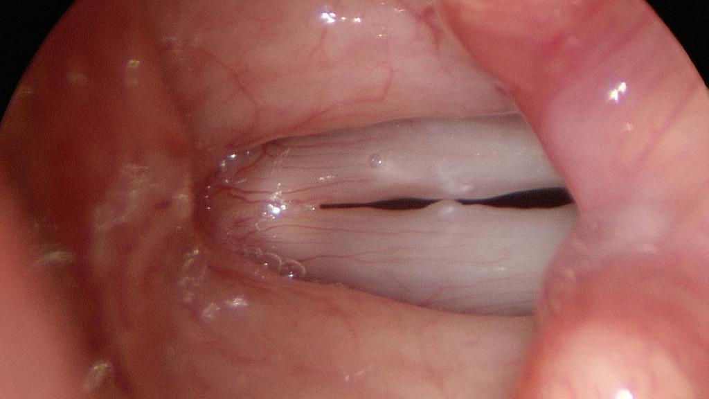 High pitch, vocal cords long and tense - marginal lesions are pushed into the central glottic opening Recording at low pitch removes any inadvertent or obligate compensation by the cricothyroid