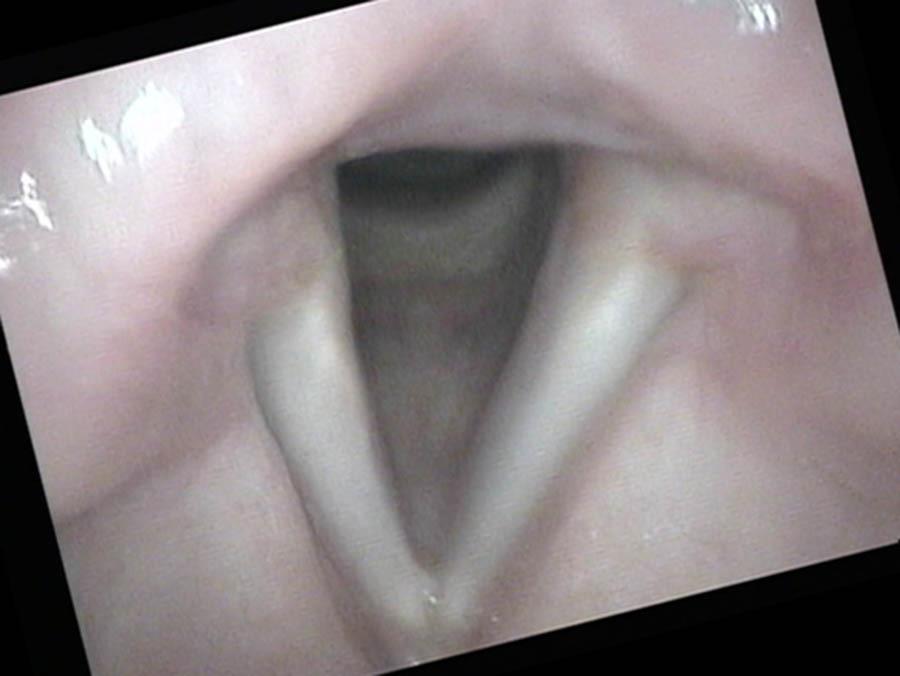 Highlights gaps, stiffness, elevations High volume Highlights weakness Monitoring the vocal cords closely during quiet respiration can detail subtle neurologic findings.