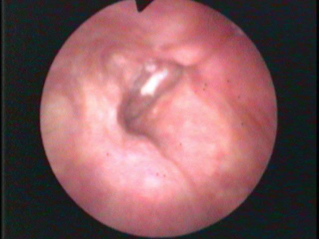 Fiberoptic endoscopy Typically the flexible fiber-optic endoscope is attached to a separate camera.