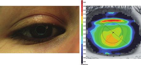 Figure 8. Example of the typical changes that can occur in corneal topography following downgaze reading tasks.