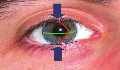 Figure 6. Illustration of the eyelid pressure theory of corneal astigmatism development.