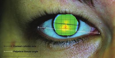 This results in WTR astigmatism, which is typically seen in the majority of young subjects. Figure 7.