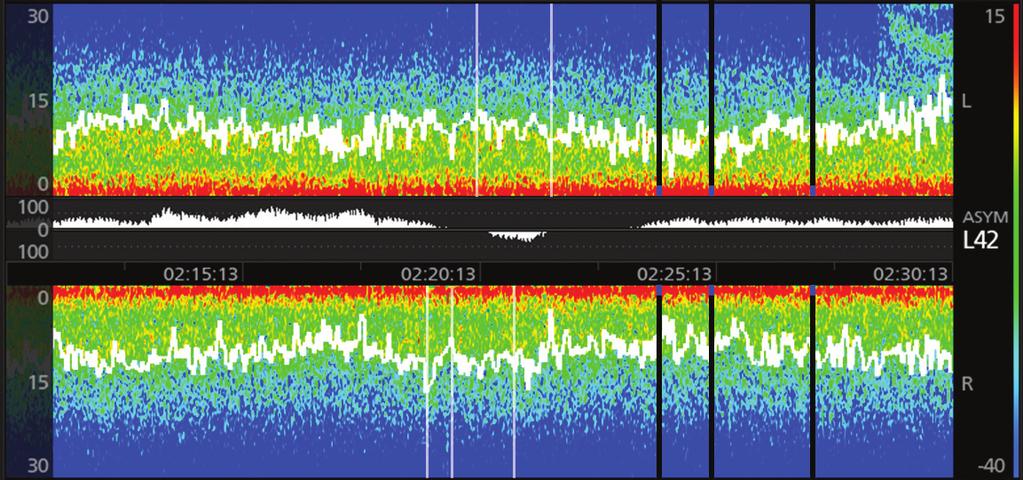 Density Spectral Array (DSA) Understanding the DSA Frequency Bands Representative EEG Waveforms Periods of artifact (ARTF) are conveyed by vertical white lines.