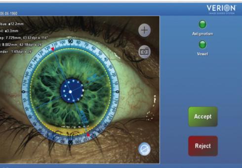 by Bonnie An Henderson, MD Bonnie An Henderson, MD Device manufacturers continue to strive for seamless integration of systems Most cataract surgeons rely on manual marking techniques when implanting