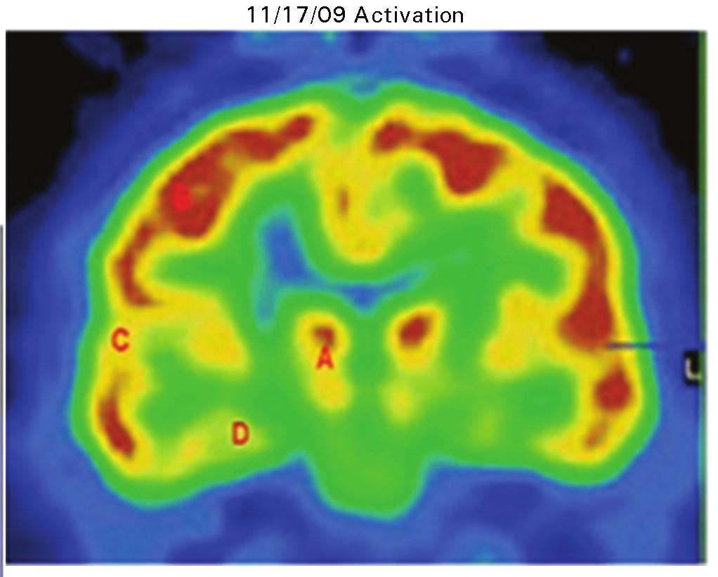 Figure 4. 11/17/09 Activation Cochlear Implant #2 Cerebral F-18-FDG PET SUV values A: Thalamus Rt; B: Frontal right; C: Primary Cortex Rt; D: Medial temporal lobe Rt; Table 1. Figure 5.