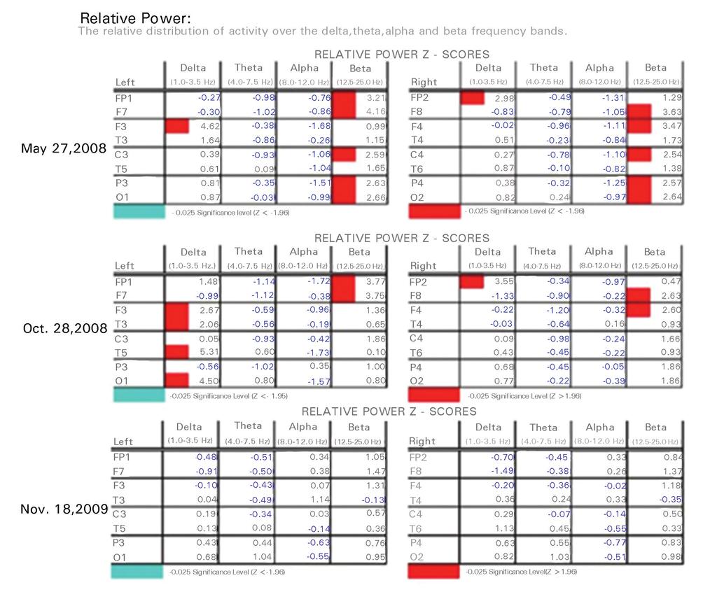 Table 1. F18-FDG Pet Standard Uptake values. Thalamus Primary Auditory Cortex Medical Temporal Lobe R L R/L% R L R/L% R L R/L% 5/28/08 Baseline 9 10.4-14 12 9.9 + 21 7 10-30 5/29/08 Activation 5.1 4.