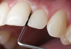 20 Secretul implanturilor dentare