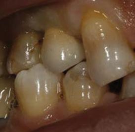 microorganisme. Odată prima barieră depăşită (gingia din jurul dintelui/implantului), bacteriile prezente la nivelul pungilor parodontale încep să însămânţeze osul adiacent (de dedesbtul pungilor).