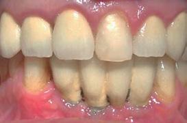 În acest sens, se consideră că fumatul este extrem de dăunător dinţilor şi implanturilor dentare deoarece fumul de ţigară are un efect constrictor (de micşorare a diametrului vaselor de sânge) de la