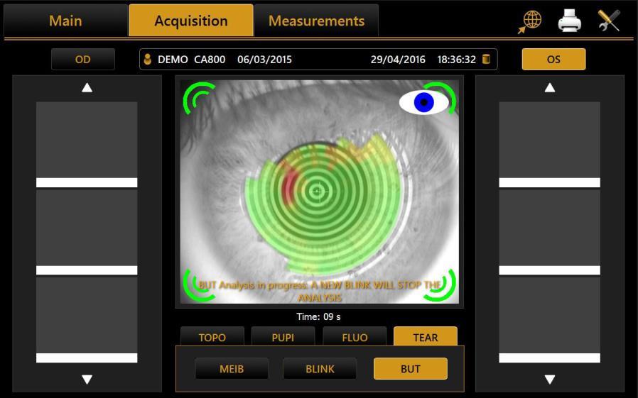 TBT(Tear Breakup Time) Acquisition cont. 5. Blink is automatically detected and analysis of the Tear Film behavior begins 6.