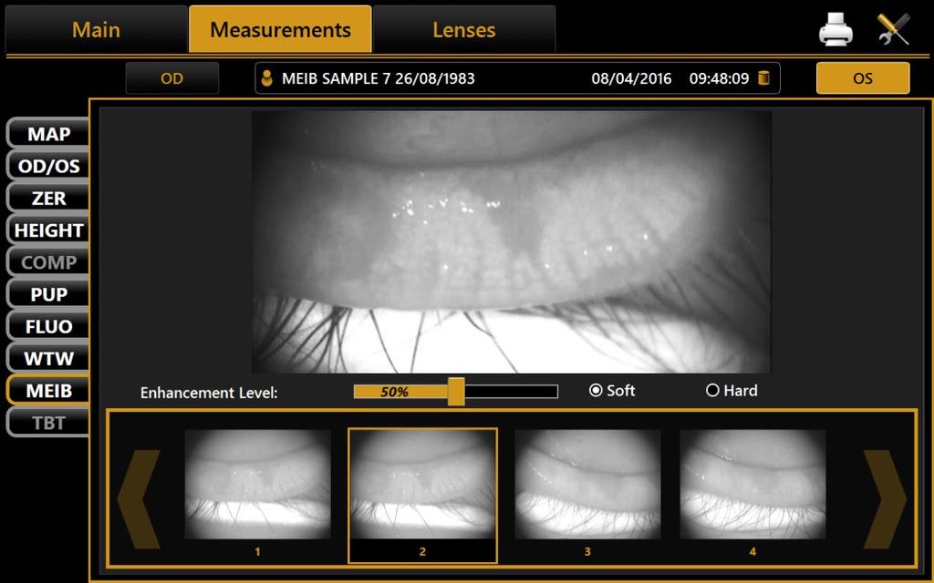 Meibomian Gland [MEIB] Viewing Meibomian Images are displayed in the center of the screen Two types of an adjustable Contrast