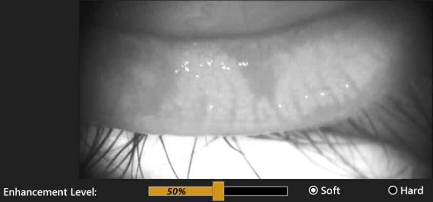 Meibomian Gland [MEIB] Viewing Contrast Enhancement Soft - 5% Soft - 50% Soft Contrast Enhancement Soft