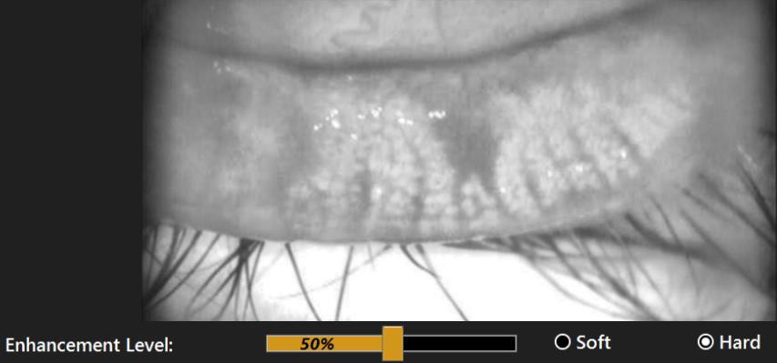Meibomian Gland [MEIB] Viewing Contrast Enhancement Hard - 5% Hard Contrast Enhancement Hard - 50% Hard