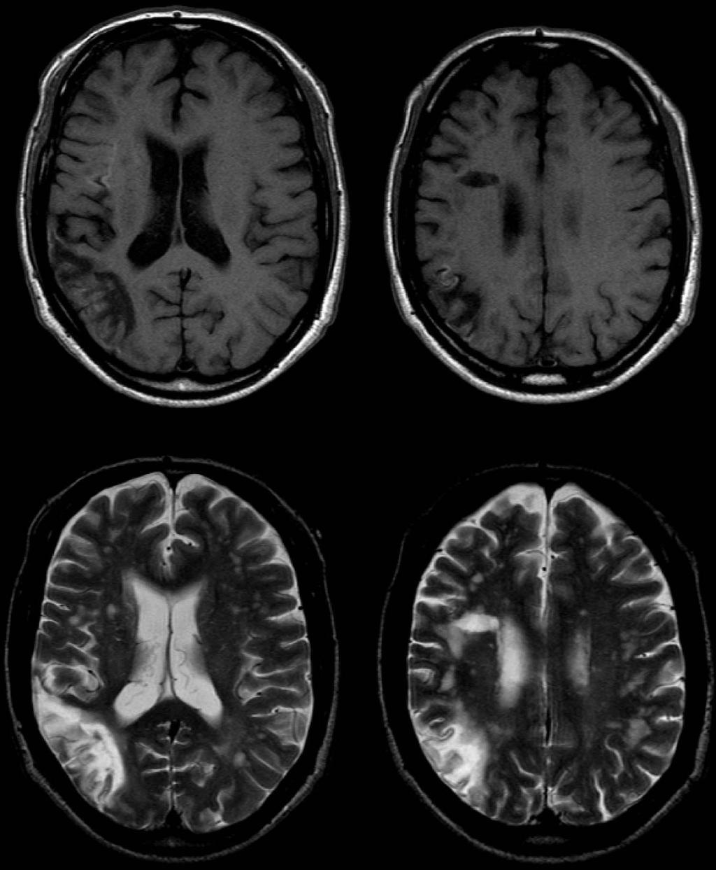 412 SATOH ET AL. Figure 1. Axial MRI images obtained 7 months after cerebral infarction. Upper and lower images show T1- and T2-weighted images, respectively.