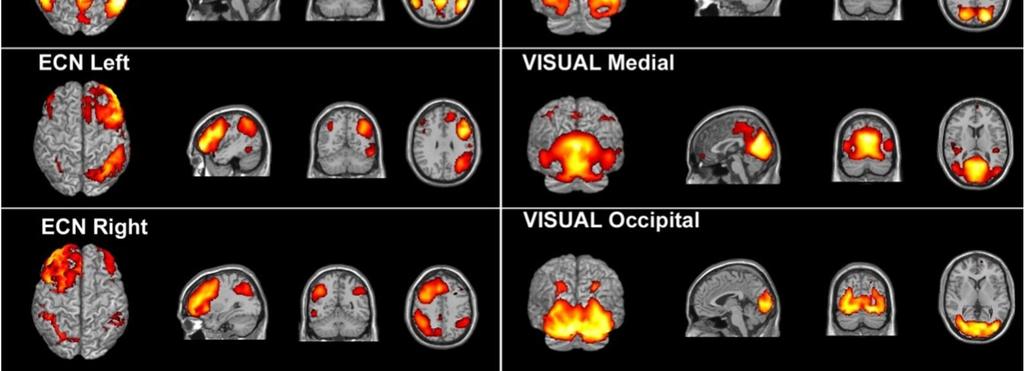 It corresponds to action-execution and perception-somesthesis paradigms. Visual networks: Included regions: medial, occipital pole and lateral visual areas.