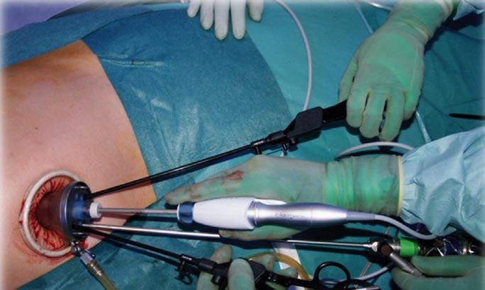 allow the insertion of endoscopic surgical staplers (Fig. 12). Fig.