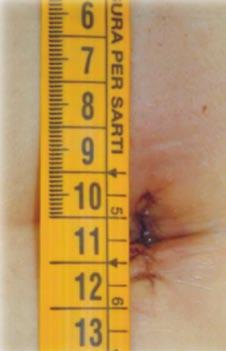 However if the specimen is bulky, it is best to remove the ENDCONE by an anti-clockwise rotation leaving the wound