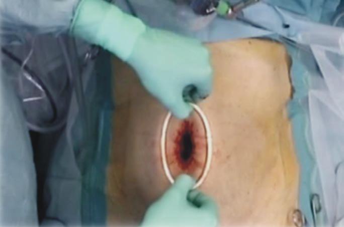 If this is the case, the incision in enlarged up to 30 35 mm along the midline through the umbilicus into the peritoneal cavity.