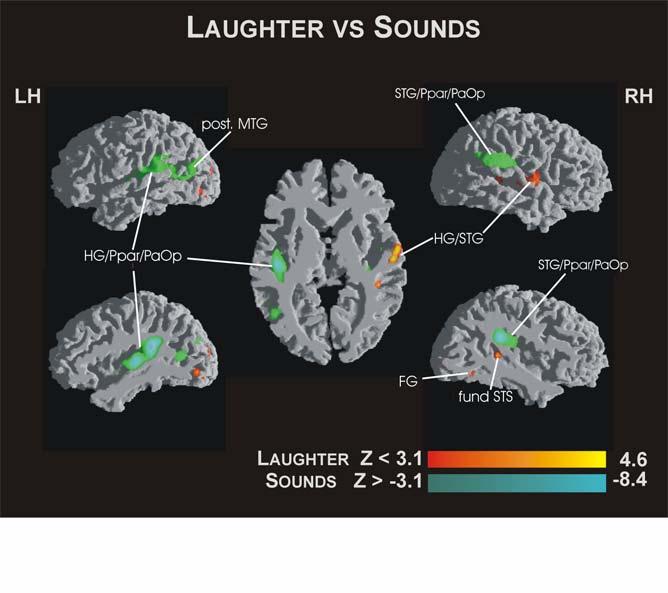 Results: Laughter: peri-auditory (pstg): acoustic and vocal suprasegmental cues somatosensory (subcg): chest vibrations premotor (ROP): laryngeal control Predominantly in the right