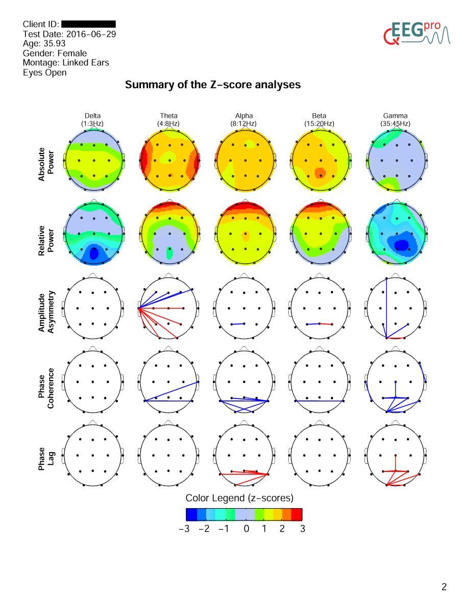 4. Summary In section 2 of the qeeg-pro report, a summary of the Z-scored results is depicted.