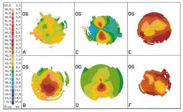 Proposed classification for topographic patterns seen after penetrating keratoplasty 405 >20 degrees Irregular X1 Angle (α) α X1/X2 > 2/3 A B < 1D Symmetric B Figure 2 Schematic illustration of the