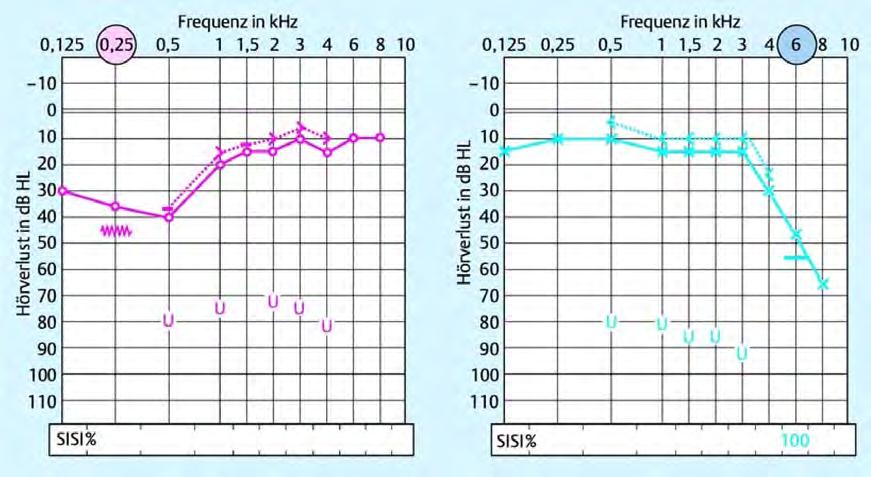2.5 Related work Frequency in khz Frequency in khz Hearing Loss in db HL Hearing Loss in db HL Figure 2.