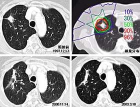 One fraction irradiation on lung cancer The treatment period and the number of fractions have been