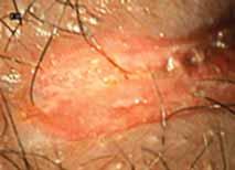 hemostază); 4) prurit intens ano-perianal (1-5 zile); 5) ţesut de granulaţie hipertrofiat (granulom) la nivelul