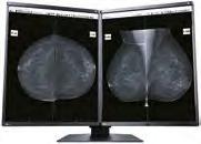 Before After Optimum Breast Screening In mammography, images are typically 5 million pixels or