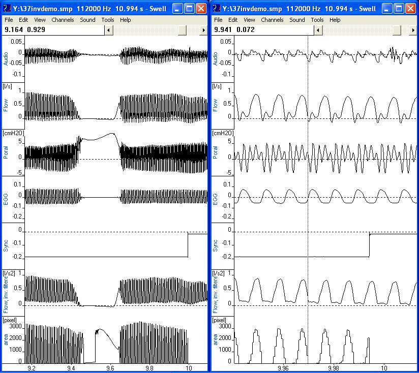 Granqvist S et al.: Simultaneous analysis of vocal fold vibration.
