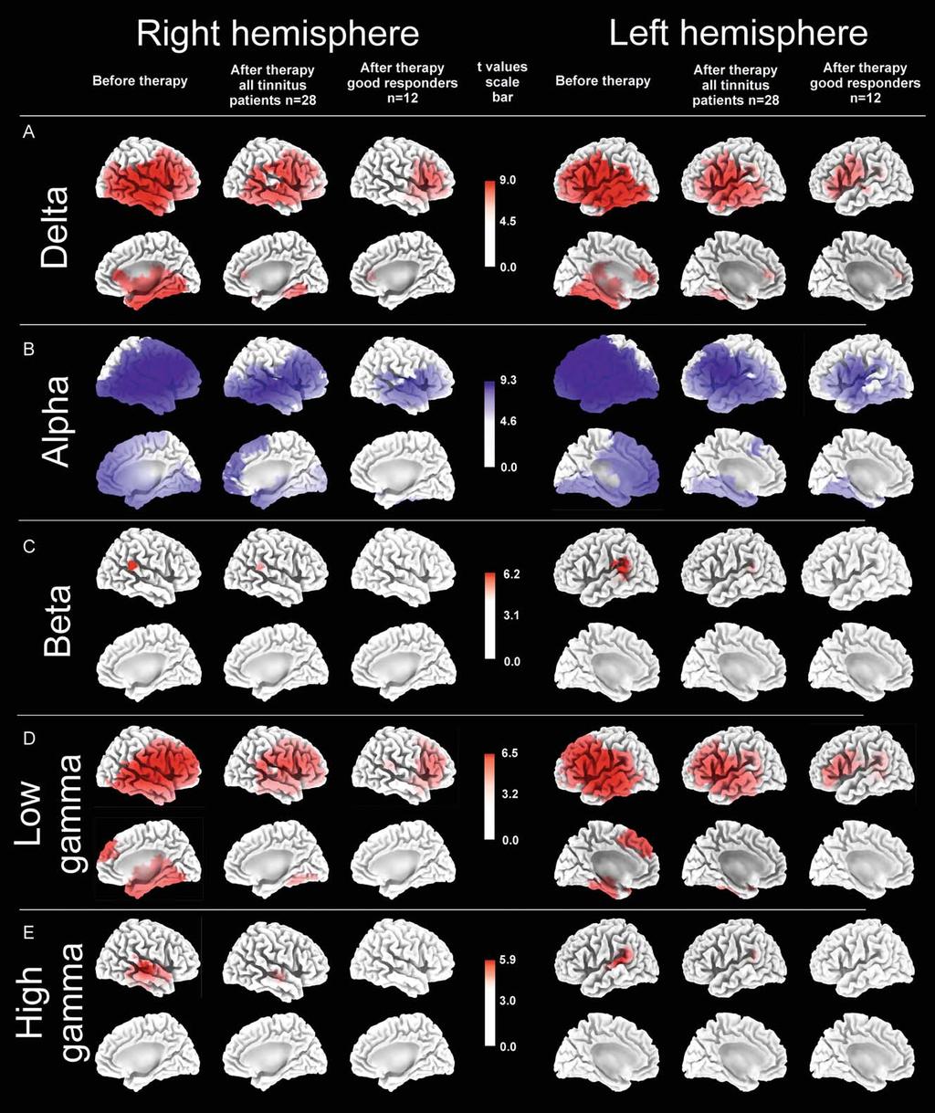 sloreta functional tomographic maps of the significant differences in the power of regional electric brain activity between all 28 bilateral tinnitus patients before therapy and healthy controls (