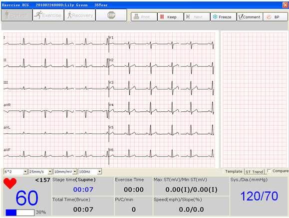 Operation Instructions for Exercise ECG 7.5.1 Viewing the Heart Rate and the Blood Pressure 1. View the heart rate in the heart rate field.