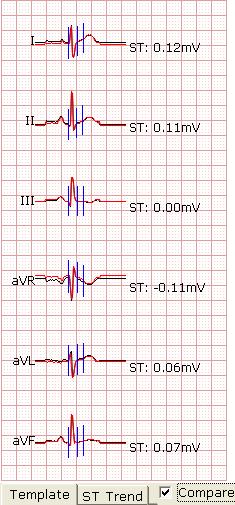 Operation Instructions for Exercise ECG Click on the Print button to print the current waveform. Click on Exit to return to the ECG sampling screen. 2.