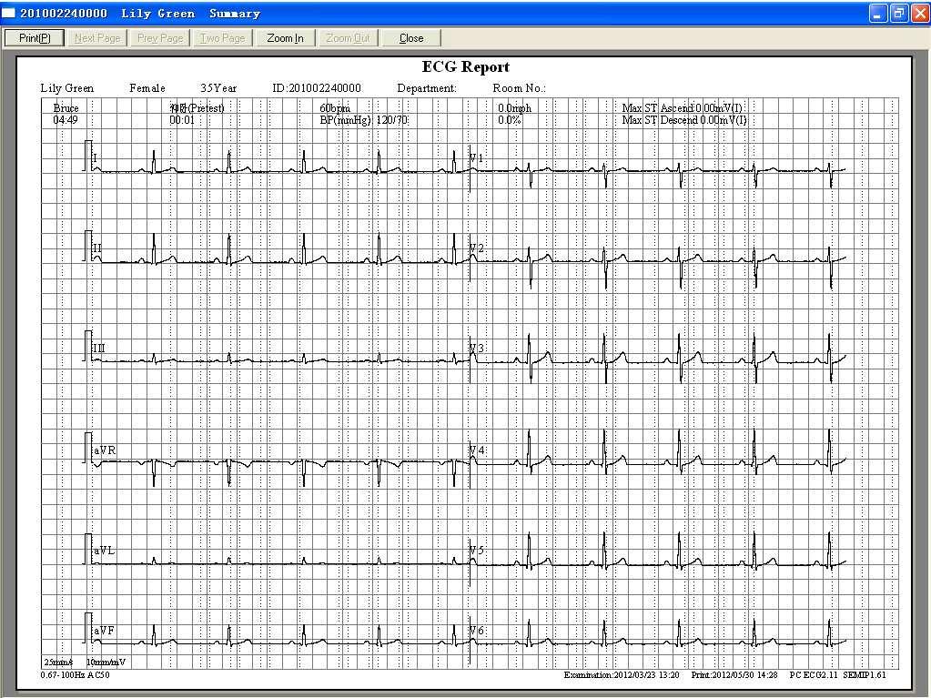 Operation Instructions for Exercise ECG Figure 7-4 Current Wave Report