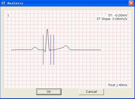 Operation Instructions for Exercise ECG 2. Click on Pretest to display 12-lead ST analysis waves of the pretest phase. 3. Click on Exercise to display 12-lead ST analysis waves of the exercise phase.