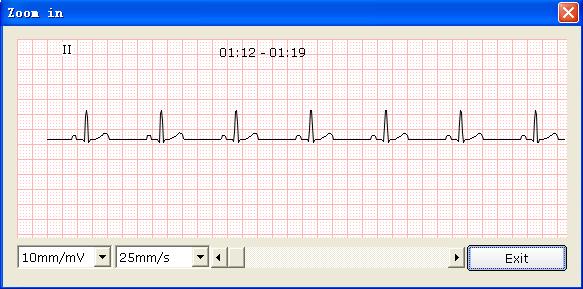 Then click on the Zoom in button to display the amplified ECG segment.