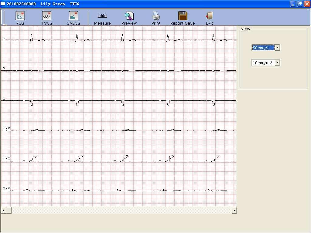 Operation Instructions for Resting ECG Figure 6-27 Time Vector ECG Screen Click on the Preview button to display the
